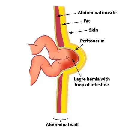 Abdominal wall hernia