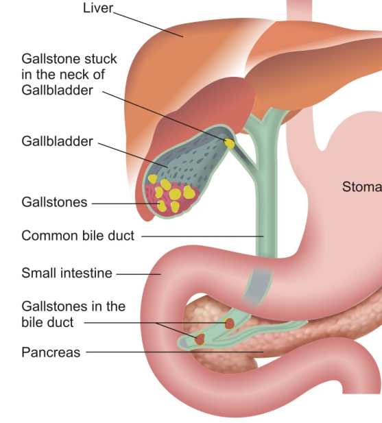 gallstones in the bile ducts gallstones in the bile ducts