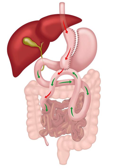 One Anastomosis Gastric Bypass Procedure Illustration