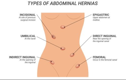 Types of abdominal wall hernias
